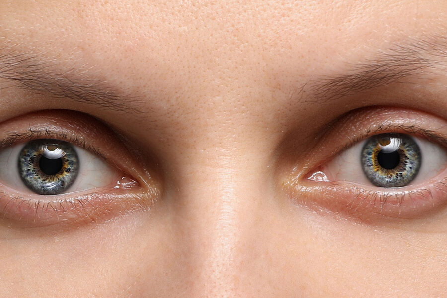 Miosis is the medical term for small or pinpoint pupils